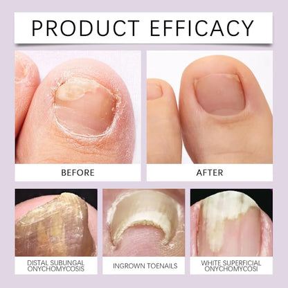 Bee Venom Nail Treatment Serum [Repair Your Nail] Buy 1 Get 1 Free 😍
